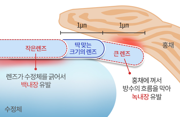 ICL 사이즈-작은 렌즈:렌즈가 수정체를 긁어서 백내장 유발, 딱맞는 크기의 렌즈, 큰 렌즈:홍채에 껴서 방수의 흐름을 막아 녹내장 유발